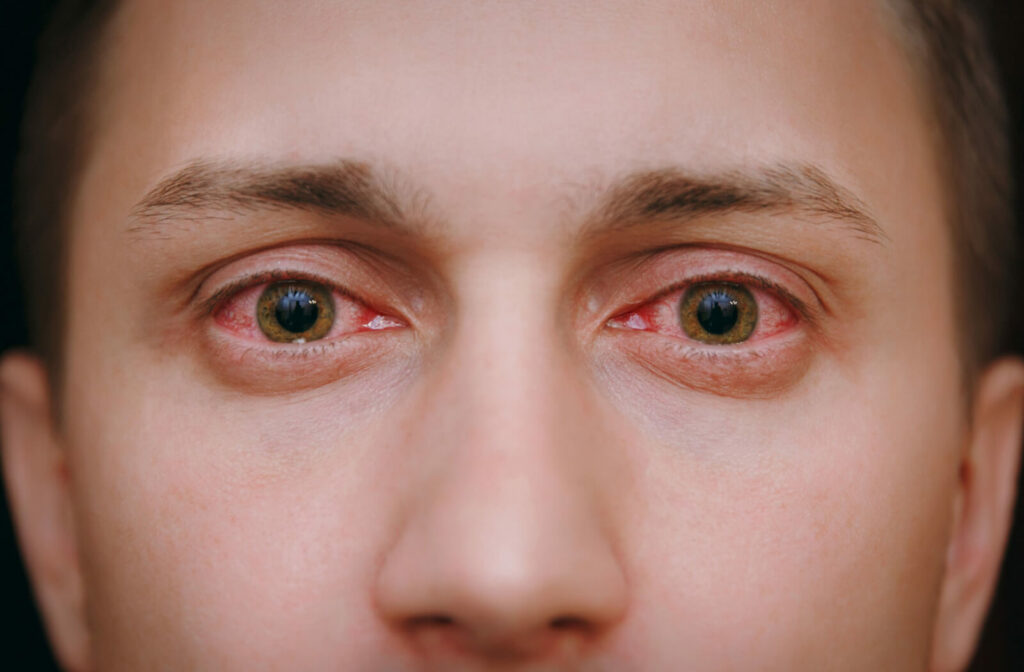 A close-up of a man with red eyes due to allergies