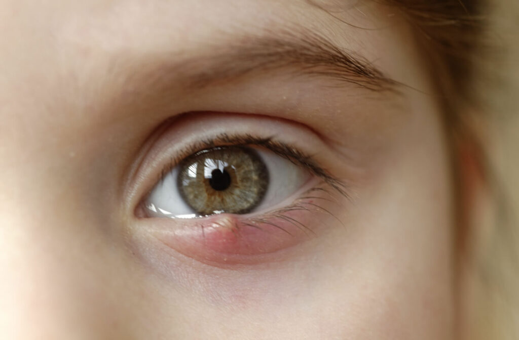 A close-up of a child's eye with a noticeable small red bump on their lower eyelid