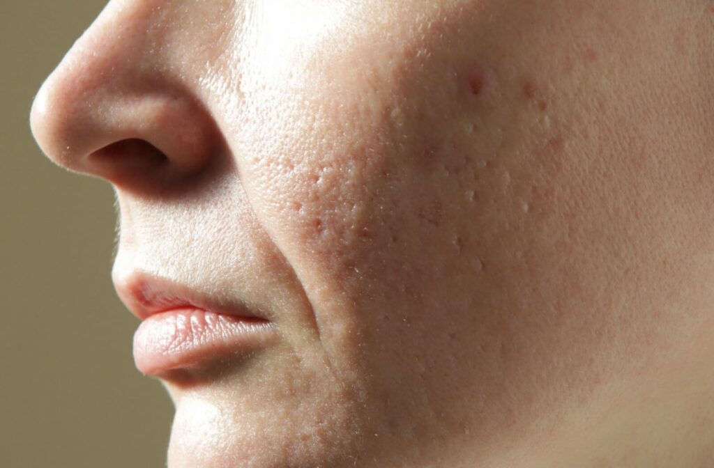A detailed close-up of a person's cheek and jawline showing visible atrophic acne scarring and uneven skin texture.